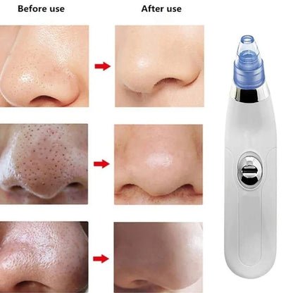 4 In 1 Multi-Action Pore Detox Tool